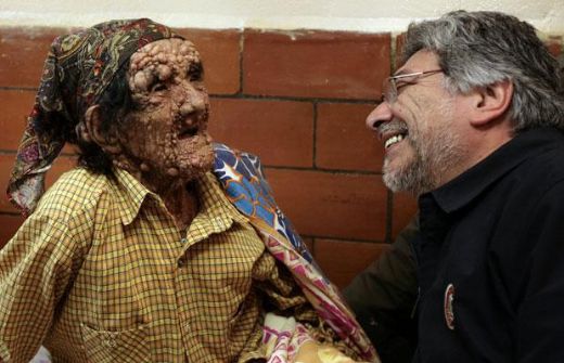 Cüzzam Nedir? Belirtileri ve Tedavisi